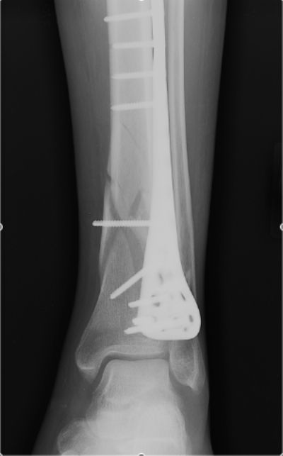 Biomet Precontoured Distal Tibial Plate (Implant 635)